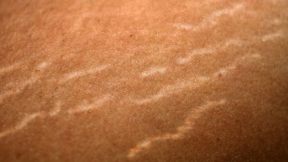 Treatment for Stretch Marks