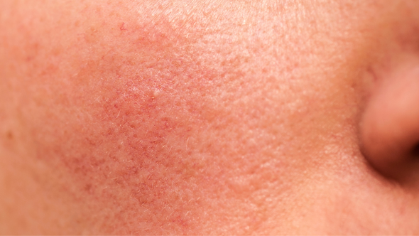 Skin Purging is a Thing: Why your skin might get worse before it gets better