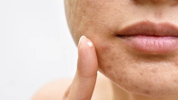 Things to Look for in a Moisturizer for Acne Prone Skin