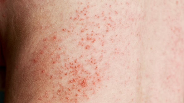 How to Treat and Eliminate Eczema on the Face