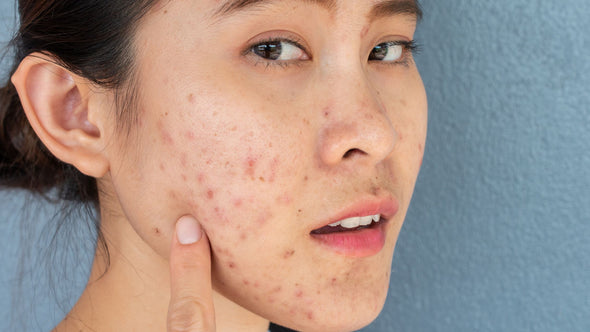 Easy Steps When Washing an Acne-Prone Face