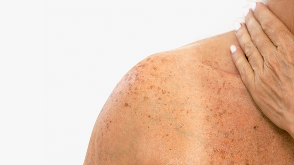 Freckles: Are they cute or are they sun damage?