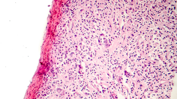 Aging Breakthroughs: Senescent Cell Removal