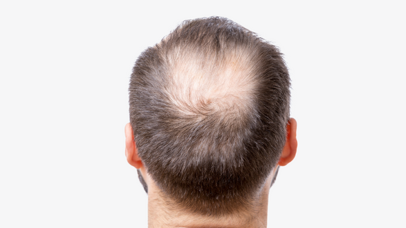 What Causes Hair Loss?