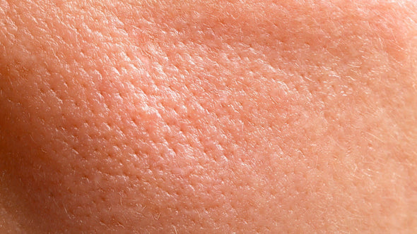 Oily Skin - Why You May Have Oily Skin & What to Do About It