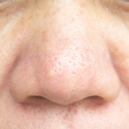 Why are my pores getting bigger as I age?