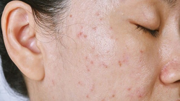 Best Treatments for Adult Acne