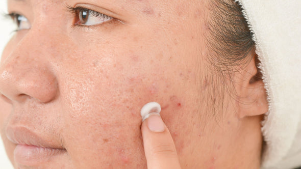 Best Moisturizer for Dry Acne Prone Skin - How to Keep Your Skin Healthy