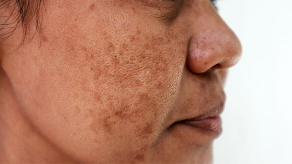 How to Get Even Pigmentation: Hydroquinone May be the Key