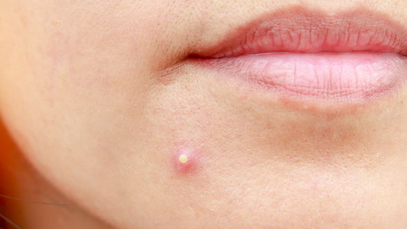 Skincare Mythbusters: Is Acne Genetic?